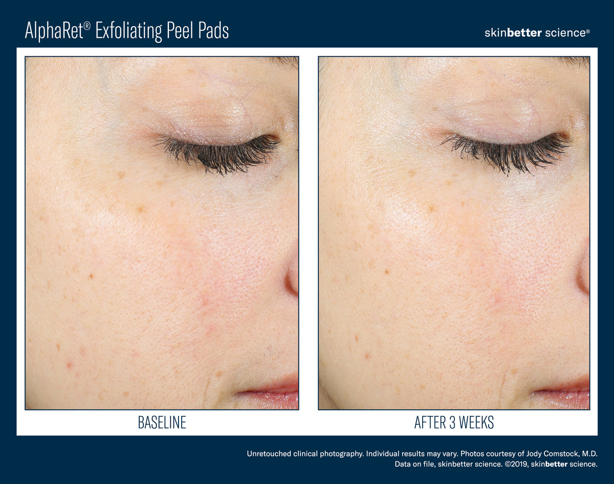 Skinbetter AlphaRet Exfoliating Peel Pads Box of 30